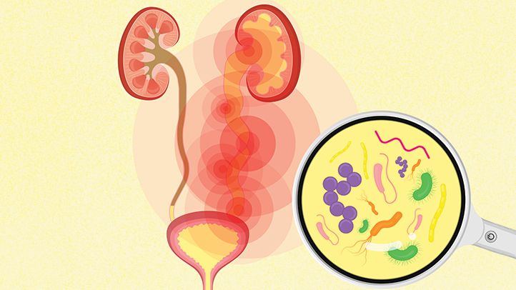 Causes of Urinary Tract Infections And Their Treatments